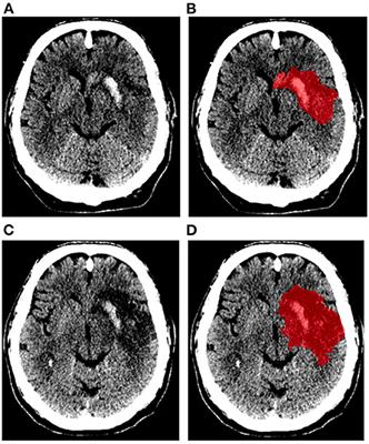 Risk factors of late lesion growth after acute ischemic stroke treatment